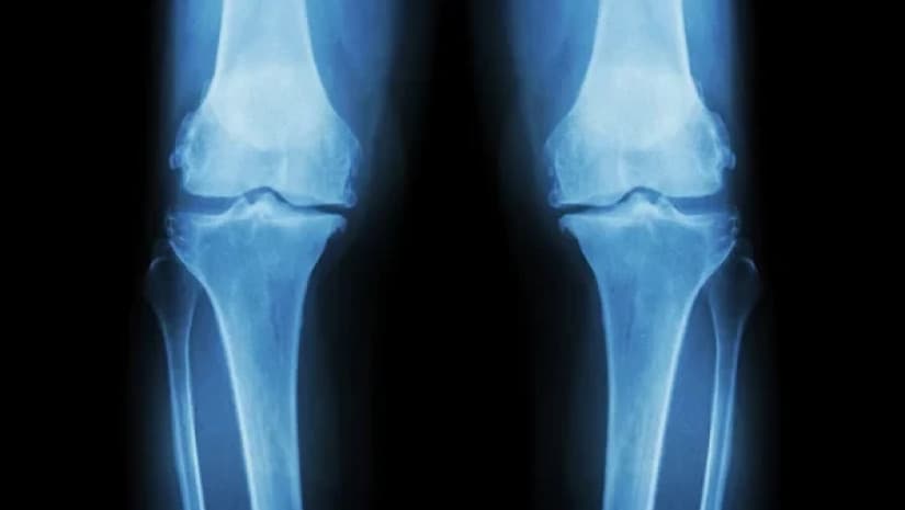 მეცნიერებმა ასაკით დაზიანებული სახსრების ხრტილები აღადგინეს – დიდი გარღვევა ოსტეოართრიტის მკურნალობაში